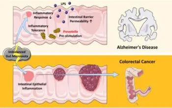 Alzheimer Hastalarının Neden Kansere Daha Az Yakalandığı Bulundu