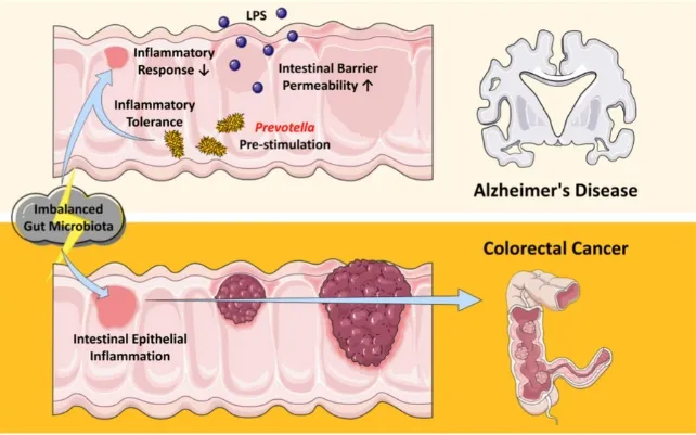 Alzheimer Hastalarının Neden Kansere Daha Az Yakalandığı Bulundu